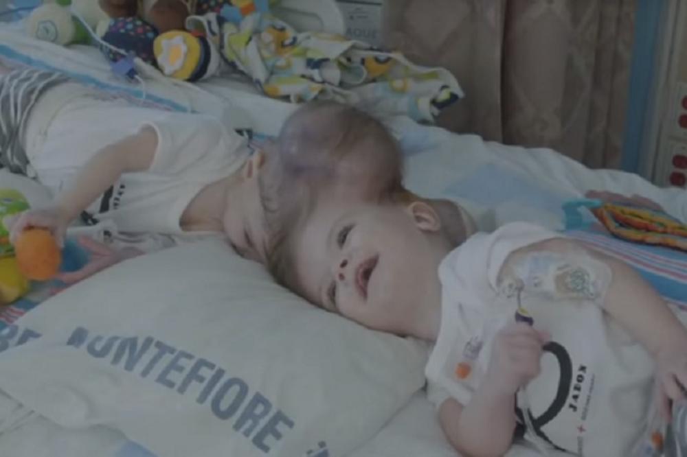 Veliki podvig hirurga: Nakon 17 sati uspešno odvojeni sijamski blizanci! (FOTO) (VIDEO)