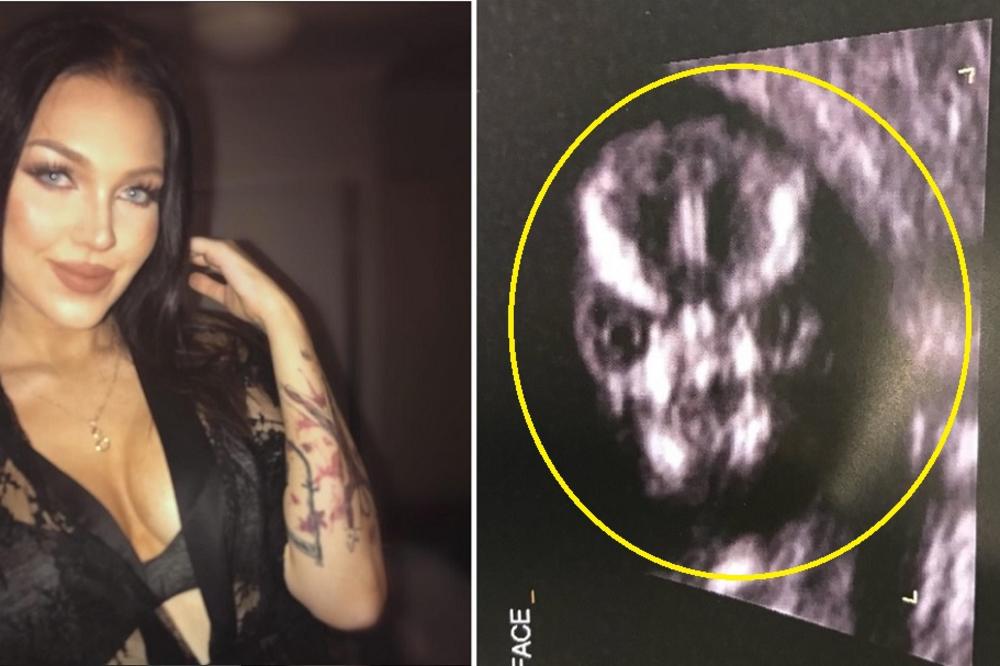 Otišla na ultrazvuk, a kada je videla lice svoje bebe... Svi su joj rekli da odmah abortira, a njena reakcija je fascinantna! (FOTO)