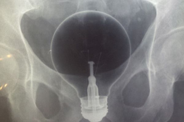 TOTALNO UVRNUTO: 22 predmeta koje su ljudi uspeli da izgube u svojim zadnjicama! (FOTO)