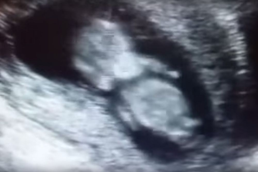 Beba koju je majka želela da abortira spasila sebi život (VIDEO)