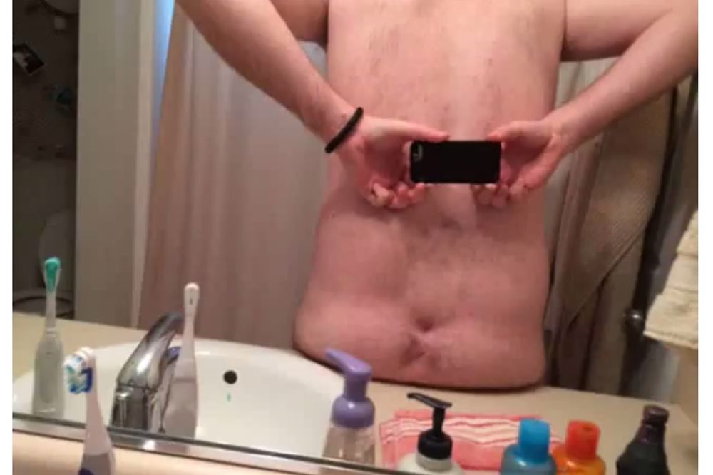 Kako je ovo moguće: Ovaj čovek nema zadnjicu! (VIDEO)