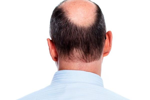 Nova kosa može da izraste: Revolucionarni izum - prevara ili spas za ćelavce?