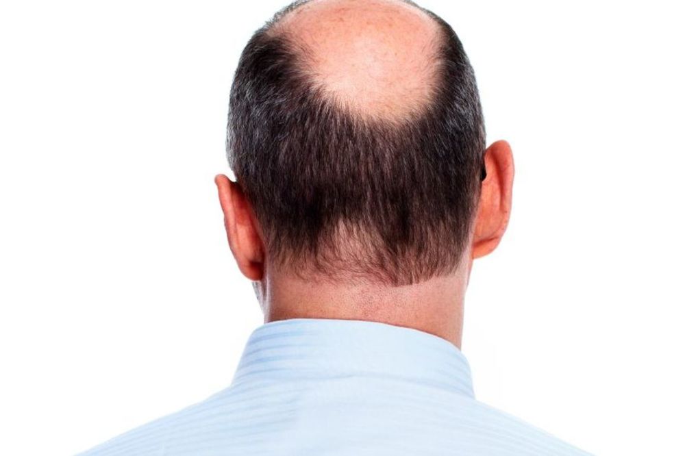 Nova kosa može da izraste: Revolucionarni izum - prevara ili spas za ćelavce?