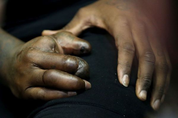 Vatromet mu je uništio šaku, amputiran mu je prst, ali je spreman da se vrati na teren! (FOTO) (VIDEO)