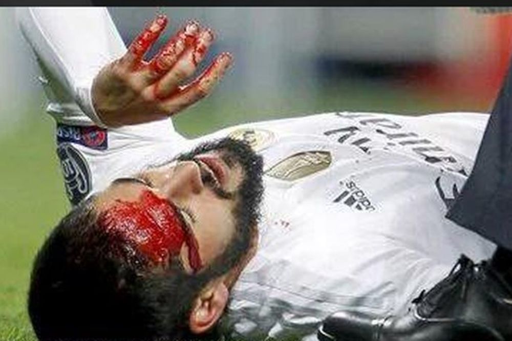 Pukla tikva na Bernabeu: David Luiz otvorio glavu Isku! (FOTO)