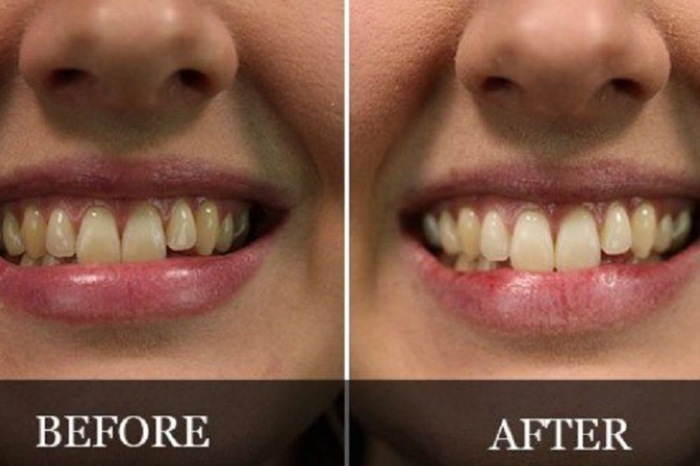 Svakog jutra prala je zube ovim sredstvom, efekat je fantastičan! (VIDEO) (FOTO)