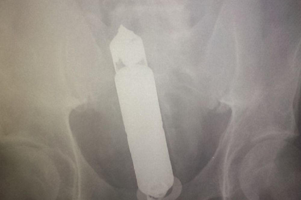 Nevaljali dekica (68): Na rendgenu mu našli seks igračku u stomaku!