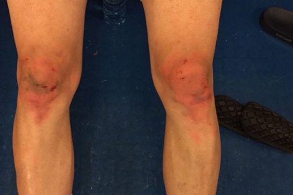 Tukli su ga nemilosrdno: Pogledajte kako izgledaju kolena Nikole Kalinića! (FOTO)