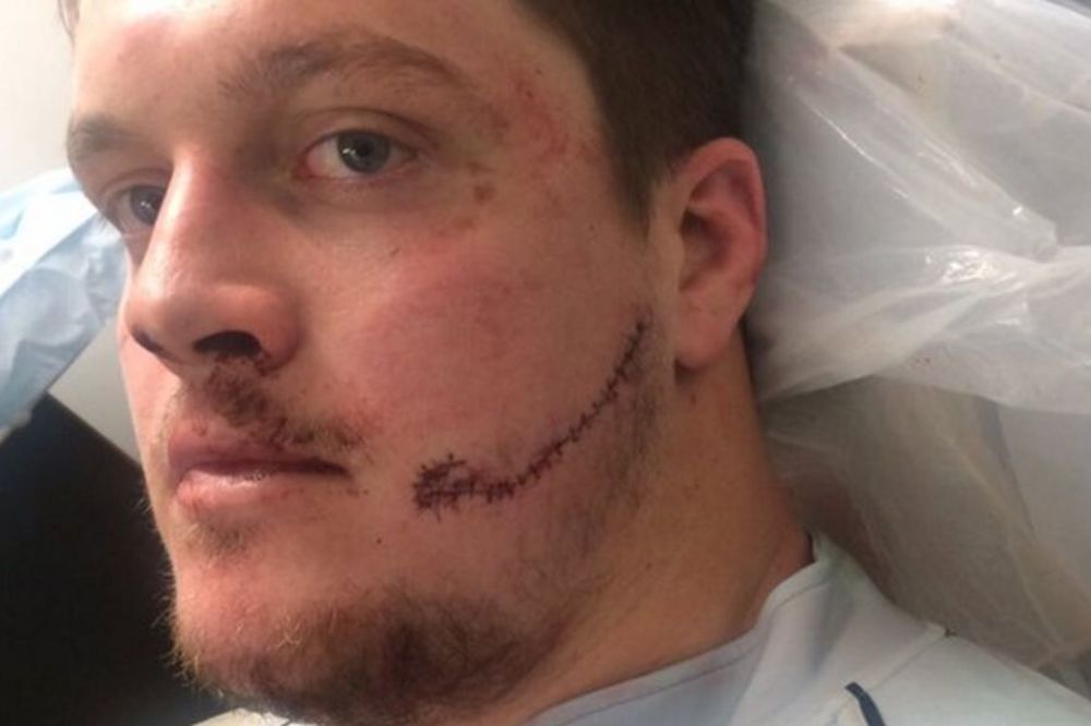 Jeziva povreda ragbiste: Kroz obraz su mu se videli zubi! (UZNEMIRUJUĆI FOTO)