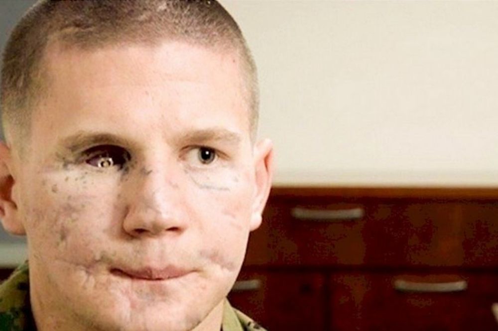 Pre 5 godina skočio je na bombu da bi spasao prijatelja. Danas izgleda kao Terminator! (FOTO) (VIDEO)