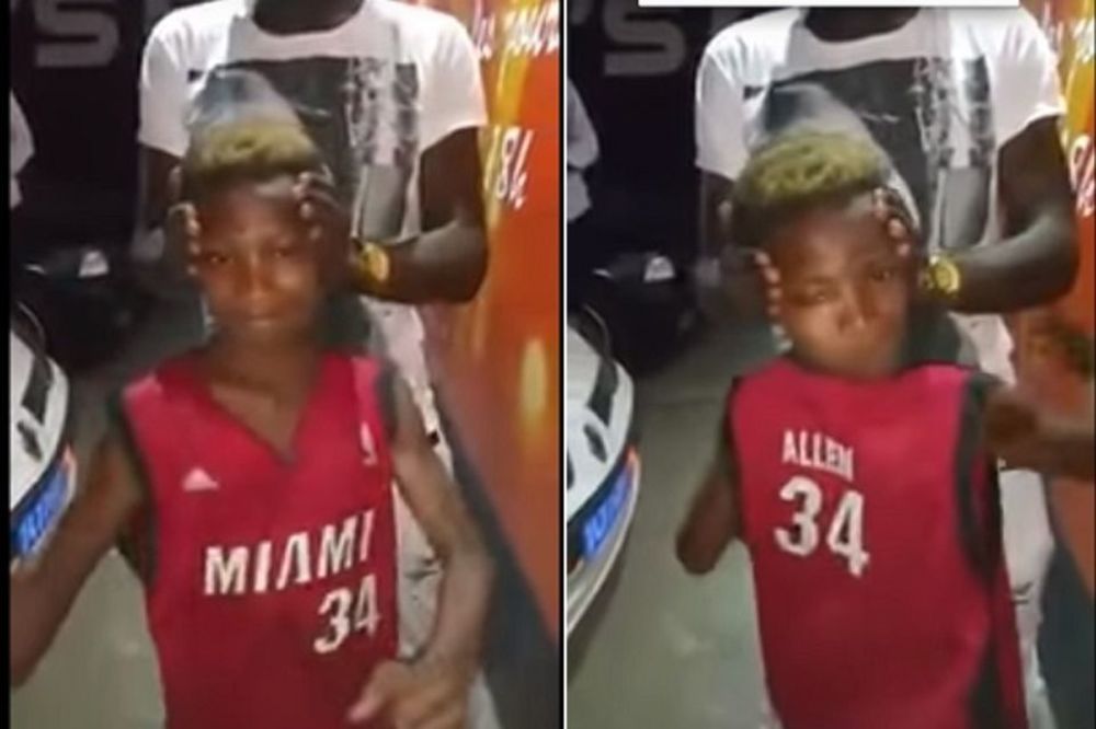 Dečak sa očima na potiljku: Njegova glava se okreće za 180 stepeni! (VIDEO)
