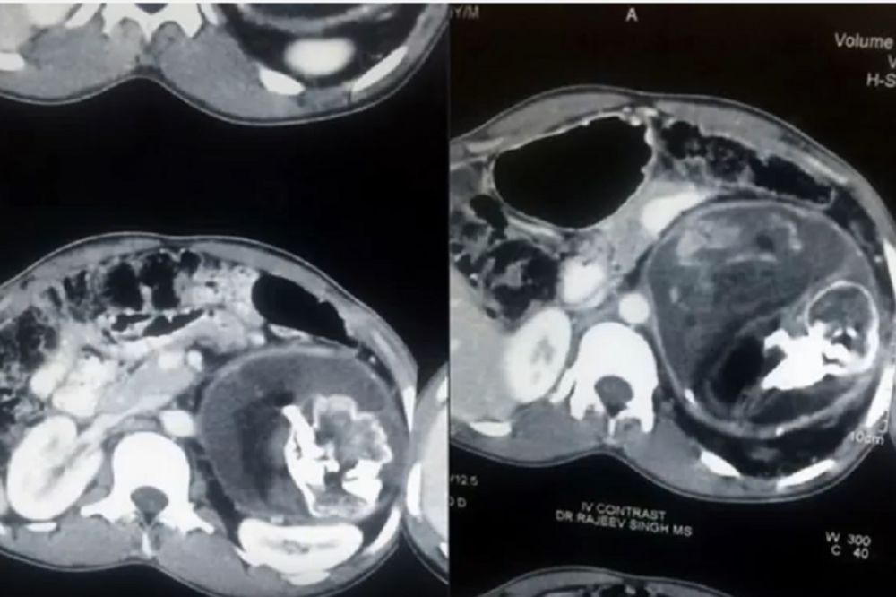 Horor! Mladiću iz stomaka izvadili kosu, zube i kosti brata blizanca! (VIDEO)