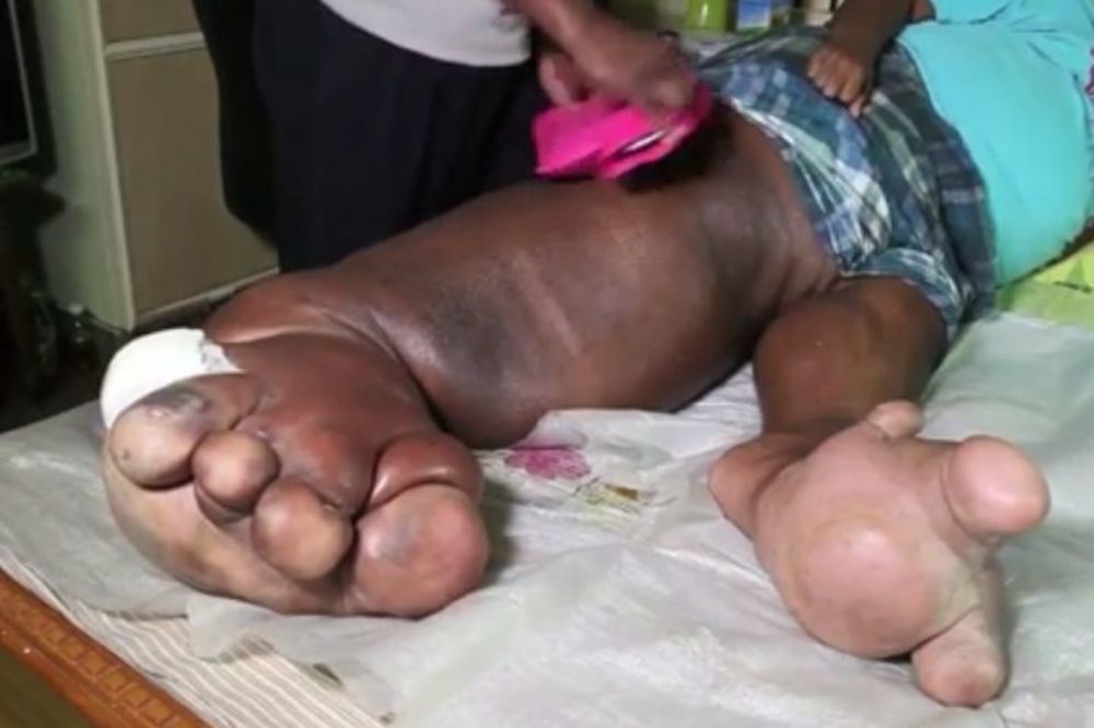 Ima nogu tešku 100 kg, kažu da mu nema pomoći! (FOTO) (VIDEO)