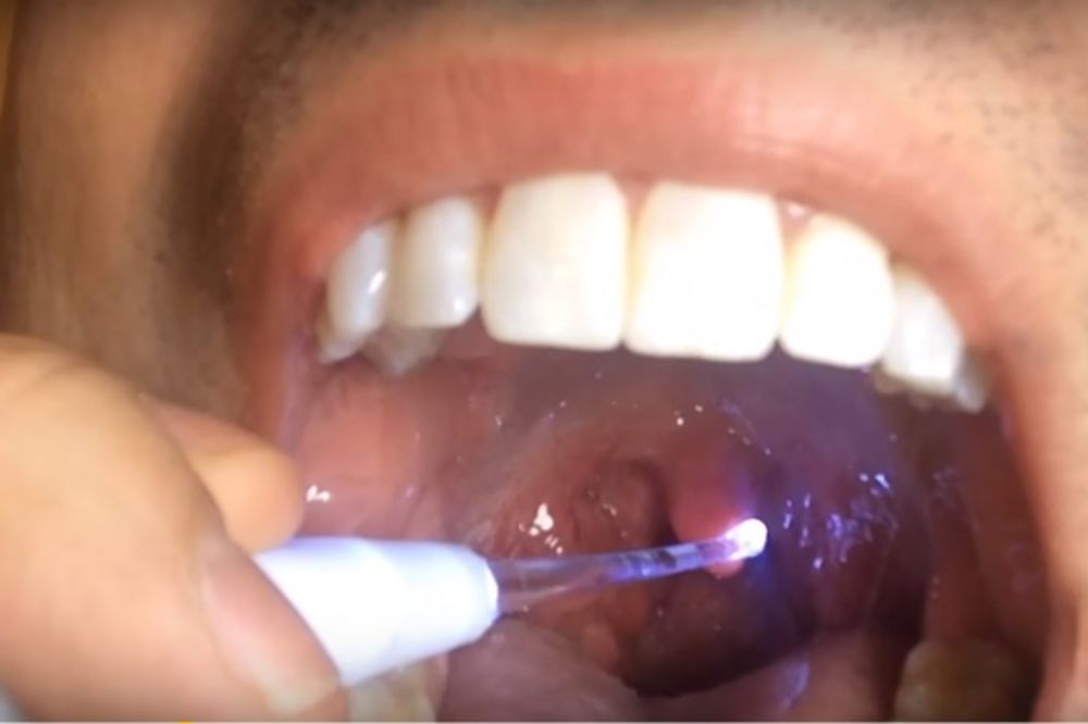 Ako imate neugodan miris iz usta, možda imate ovo, a da to niste ni znali (VIDEO)