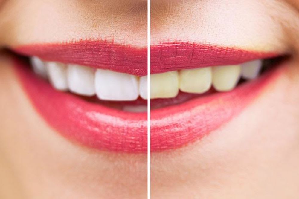 Pušite i pijete mnogo kafa? Izbelite zube za 7 dana uz pomoć ovog začina (FOTO) (VIDEO)