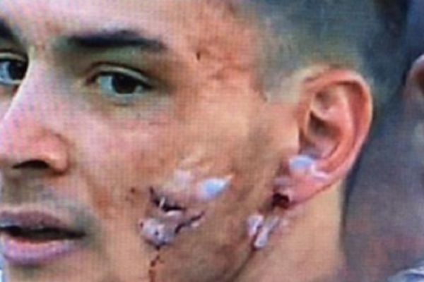 Kramponi u lice: Fudbaler Verone unakazio beka Milana! (VIDEO)