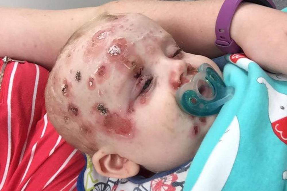 Majke, ako ne želite da vam deca ovako izgledaju - vakcinišite ih! (FOTO)