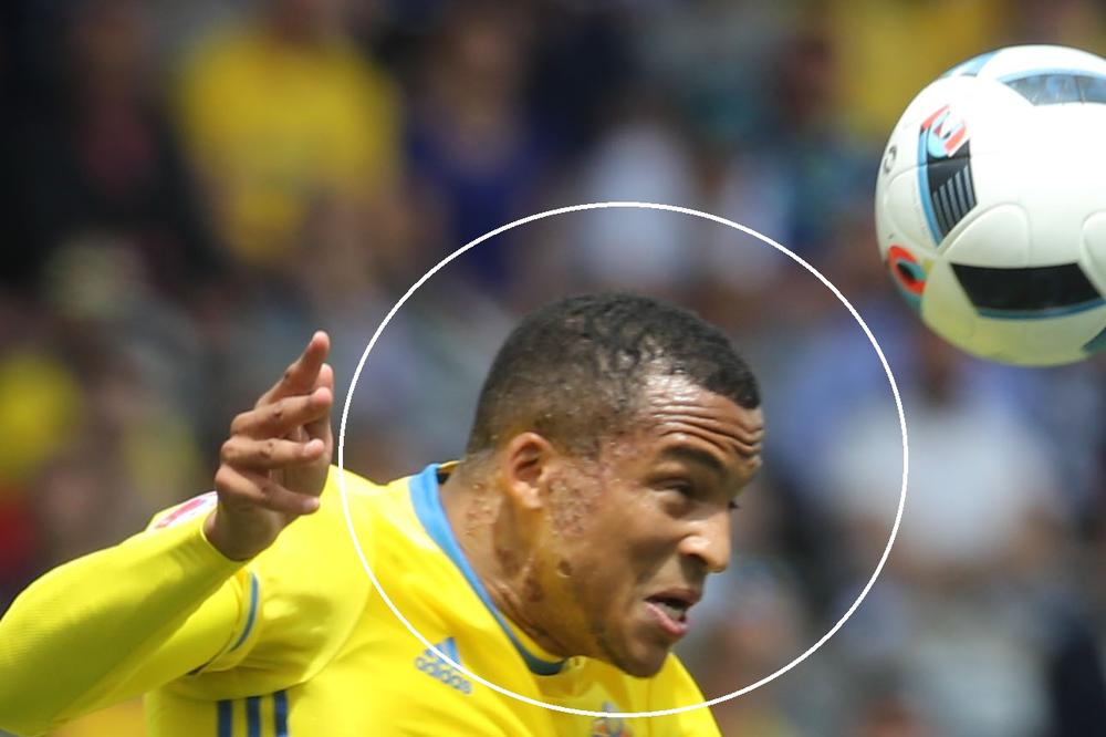 Kakve veze ima Šveđanin sa bonžitom? Lice reprezentativca Švedske je sprženo! (FOTO)