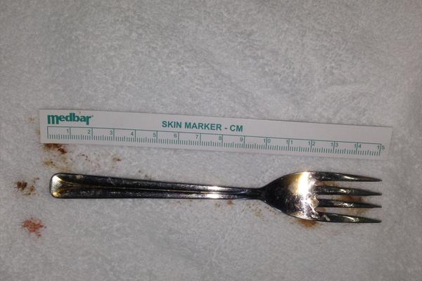 Lekari ovo nisu videli do sada: Lik je progutao viljušku! (FOTO)