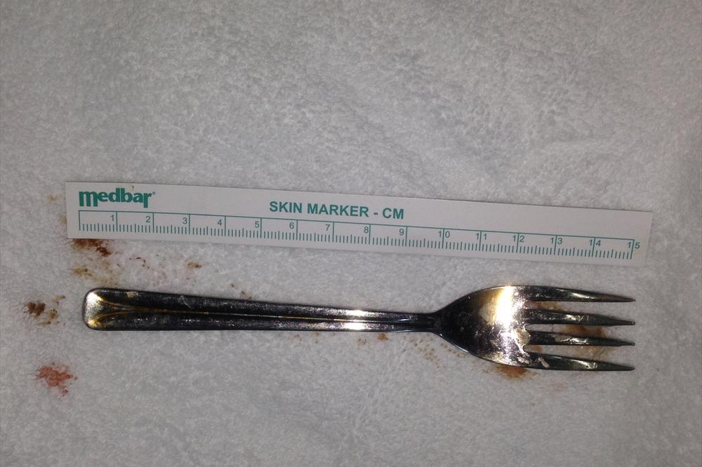 Lekari ovo nisu videli do sada: Lik je progutao viljušku! (FOTO)