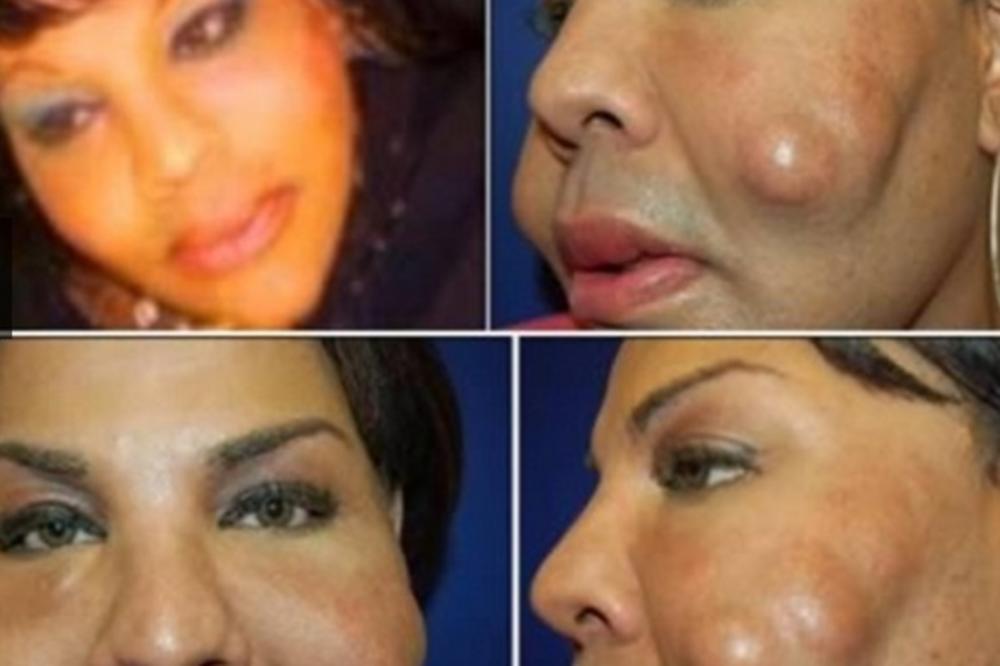 Da li su tužili hirurga? 10 ljudi koji su uništeni na plastičnim operacijama! (FOTO)