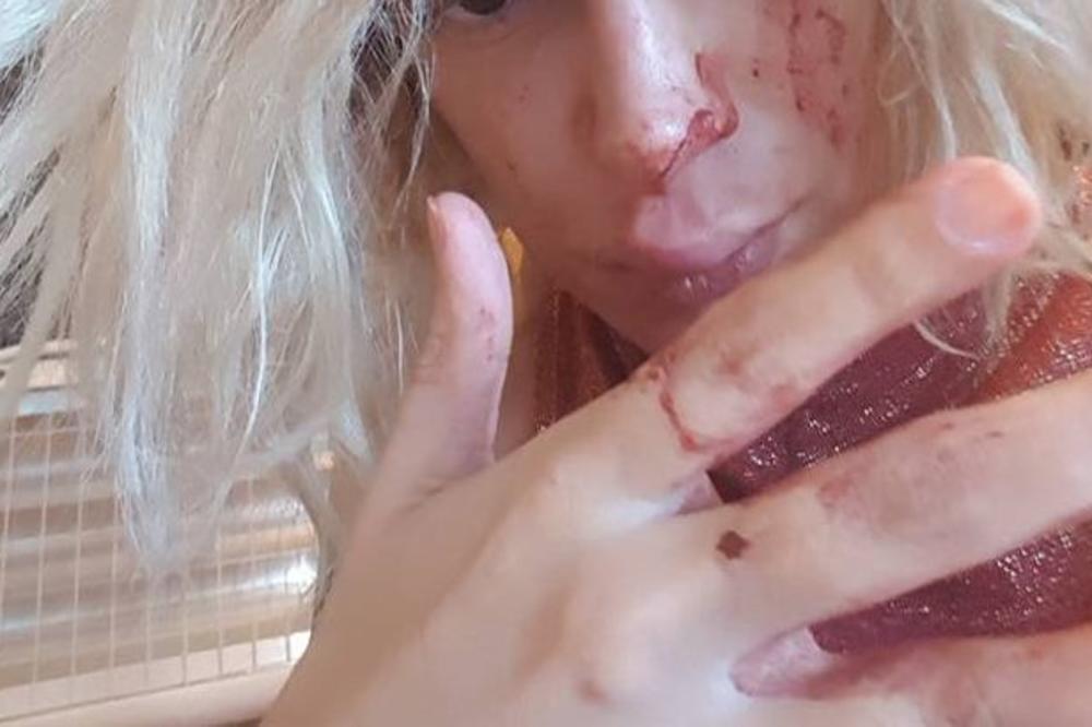 Srpska pevačica brutalno pretučena: Bravo za ovo, muškarčine! (FOTO)