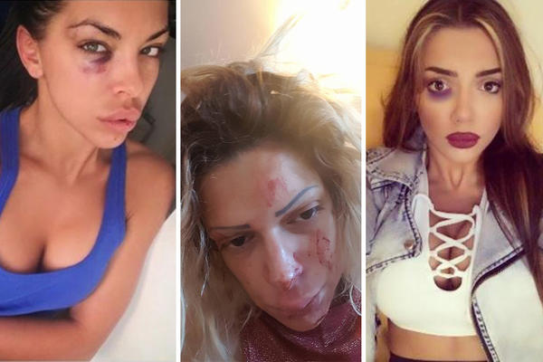 Bravo, muškarčine: Dunja nije jedina koja je pretučena, i ove naše zvezde su popile opasne batine! (FOTO)