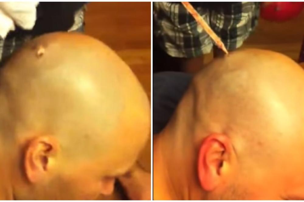 Nešto ga je svrbelo na potiljku, a onda je krenulo da izlazi... i izlazi (VIDEO)