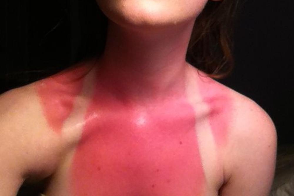 DERMATOLOG SAVETUJE: Ovo je najbolji LEK za OPEKOTINE!