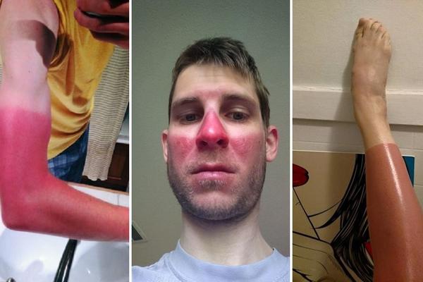 Mislili su da je kul da imaju štrafte preko nosa ili su samo zaboravili kremu za sunčanje? Plakaćete od smeha! (FOTO)