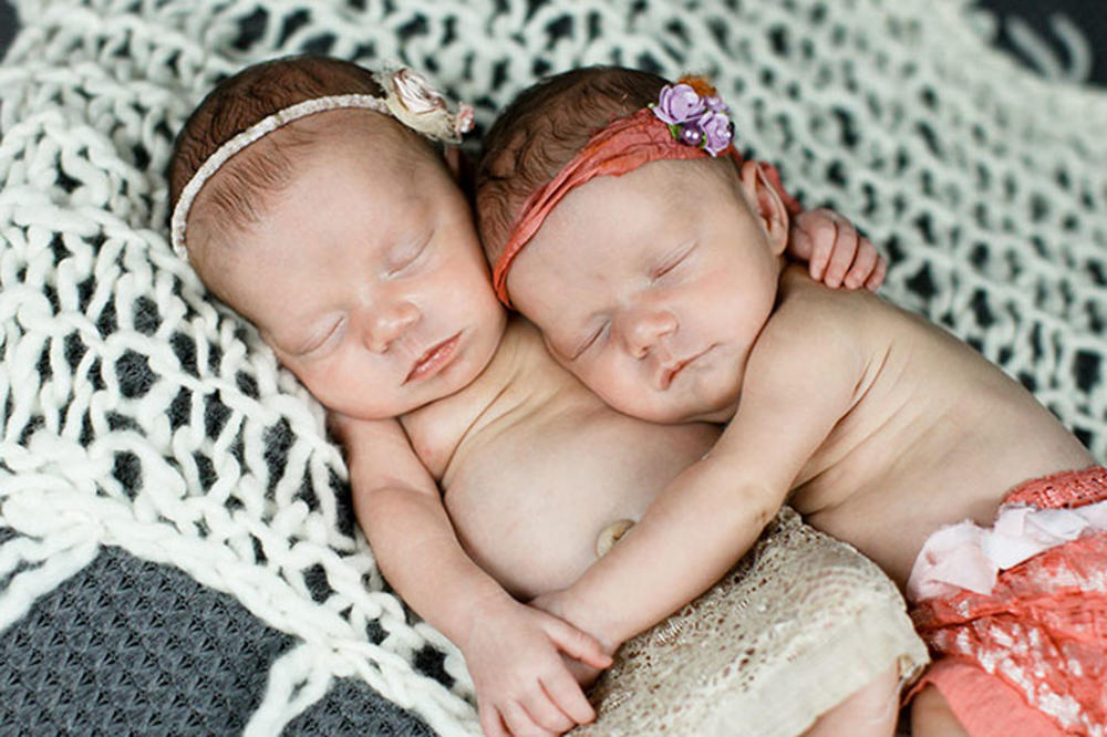 Ove bliznakinje rođene su držeći jedna drugu za ruku, evo šta se sa njima danas dešava (FOTO)