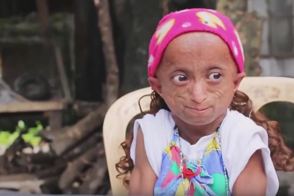 Preminula najstarija tinejdžerka: Imala 19 godina, a telo 150-godišnjakinje! (VIDEO)