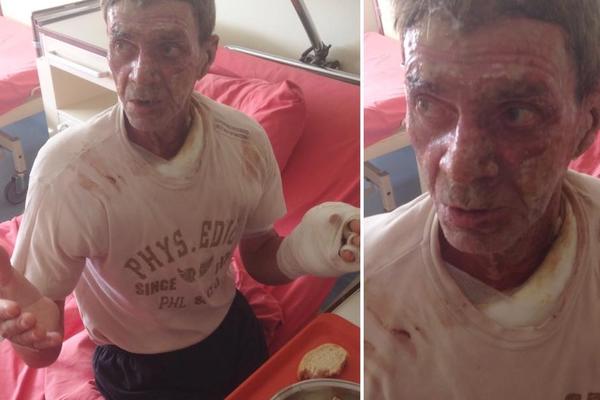 Monstrumi iz Tuzle! Zapalili prijatelja i ostavili ga da umre! (FOTO) (UZMEMIRUJUĆ PRIZOR)