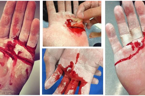 15 fotografija žuljeva gimnastičara pokazaće vam koliko su čvrsti ovi ljudi! (FOTO)