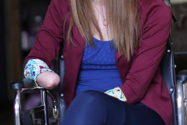 Koliko treba da si jadan?! Odsekla ruku i nogu da prevari osiguranje! (FOTO)