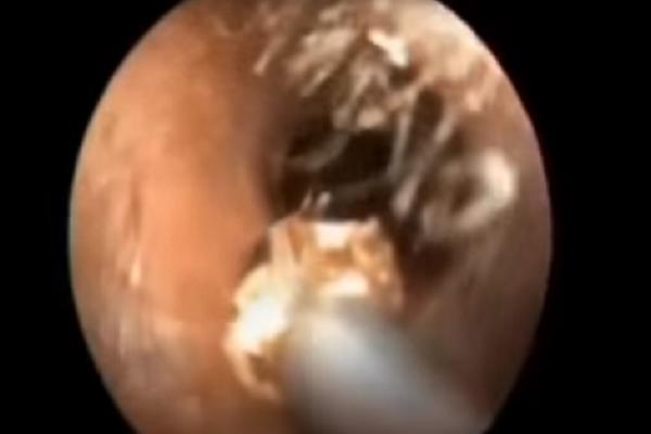 Čišćenje ušiju gore od horor filma: Nećete verovati šta su izvukli iz njegove glave! (UZNEMIRUJUĆI VIDEO)