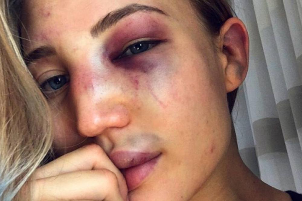 Pretučena prelepa Anastasija i još je i ponosna na to! (VIDEO)