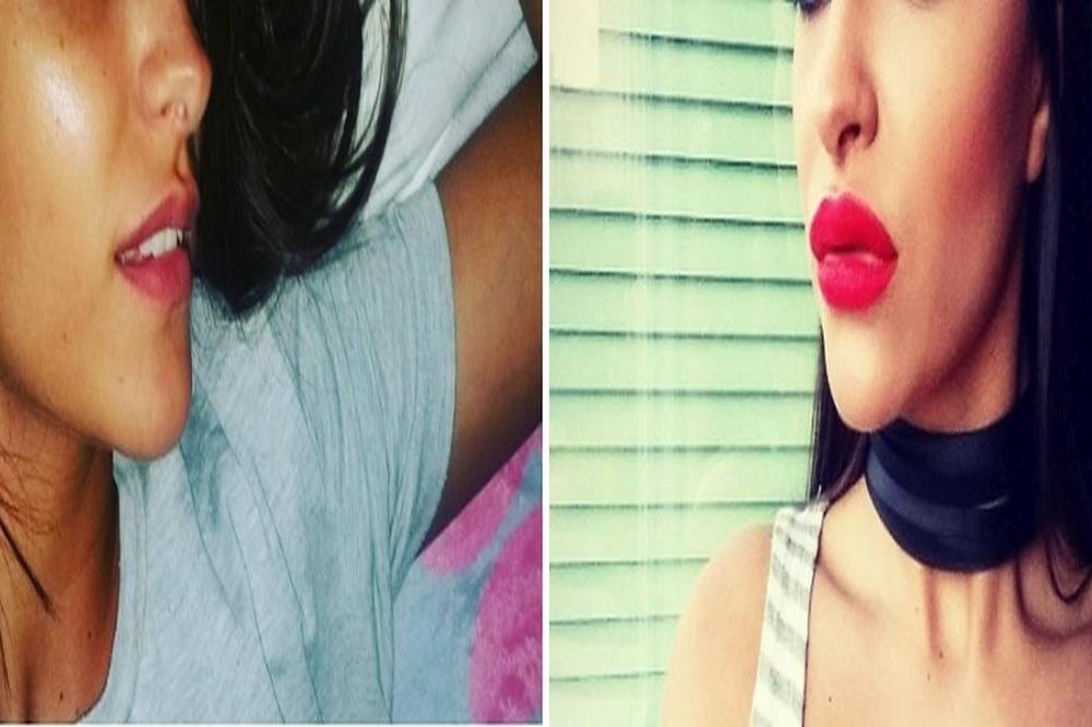 Je l je to napao roj pčela? Ružica napumpala usta i izgleda kao da ima dva valjka umesto usana! (FOTO)