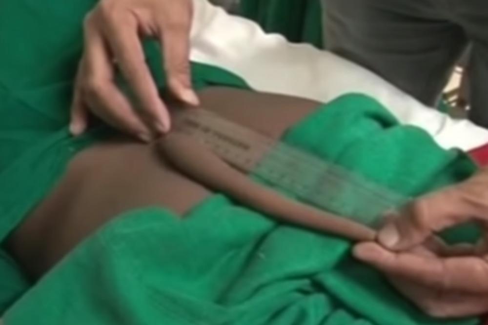 UKLONILI MU 18cm! Hirurzi tinejdžeru otfikarili bizarnu izraslinu! (FOTO)