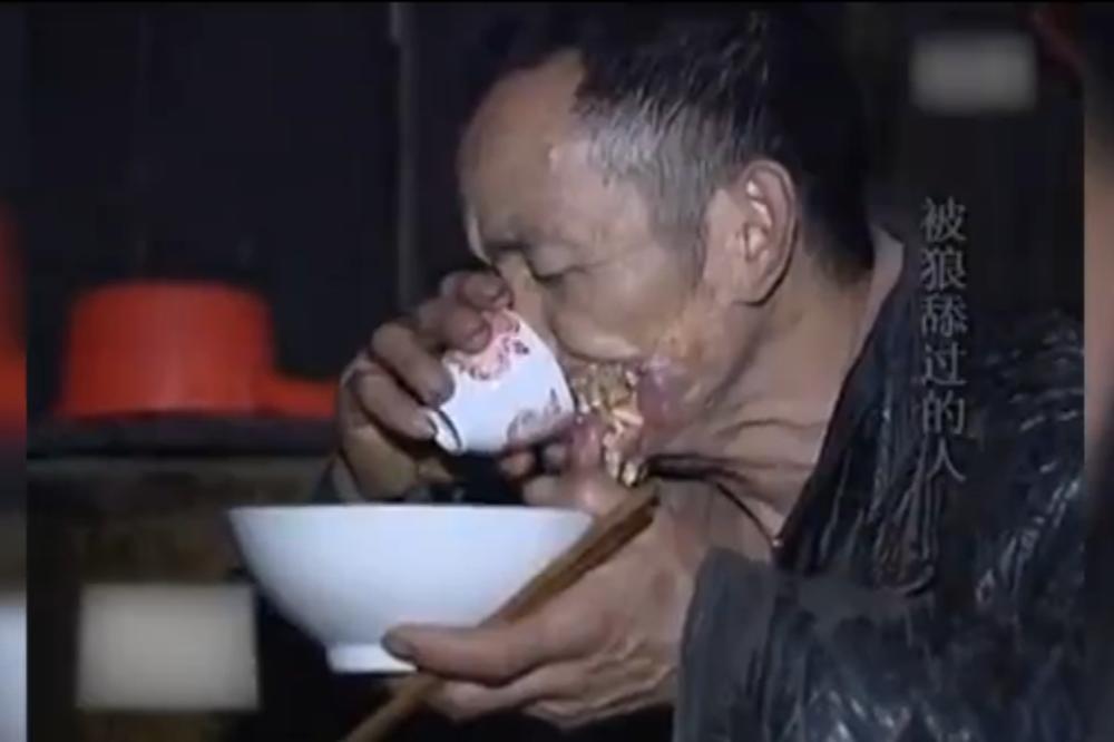 NIJE ZA GADLJIVE: Ovako izgleda čovek kojem je vuk pojeo facu! (UZNEMIRUJUĆI VIDEO)