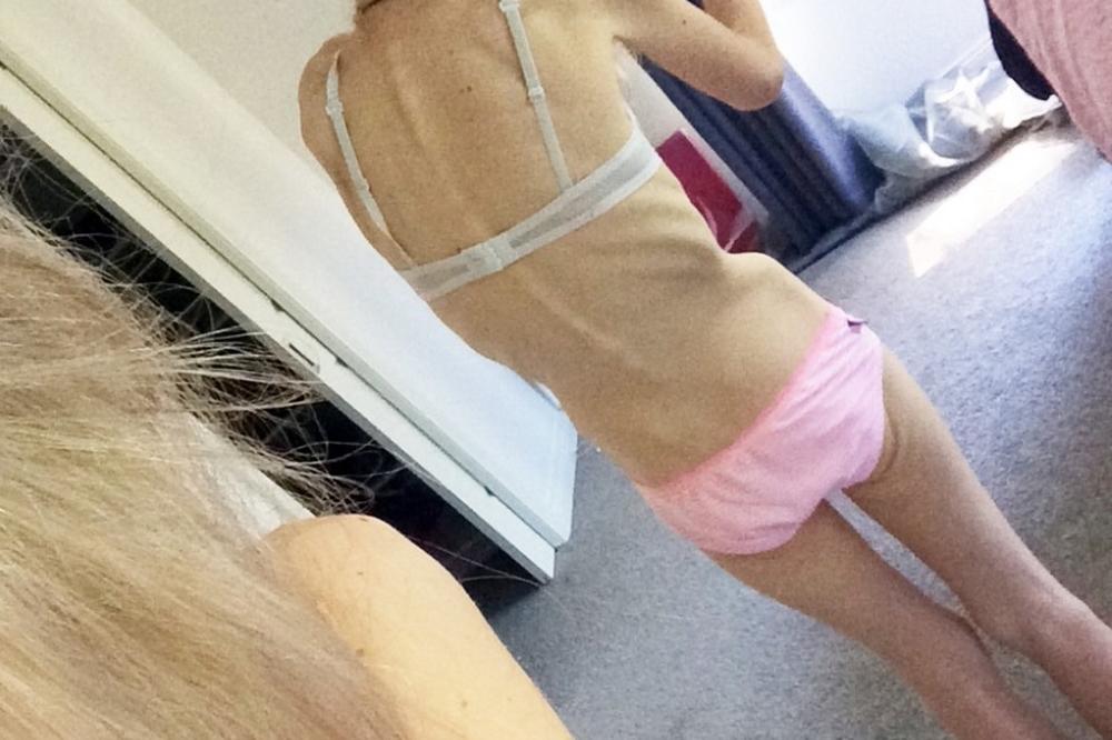 ISPOVEST ANOREKSIČNE DEVOJKE: Volim da slušam krčanje svojih creva noću! (FOTO)