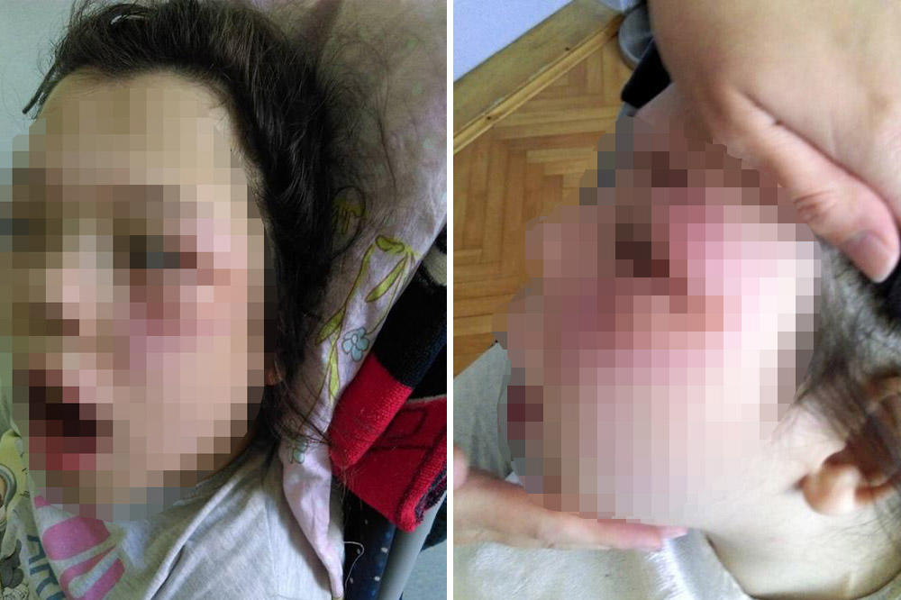 Dete joj je došlo iz boravka s modricama i iščašenom rukom - ono što se dešava 3 meseca kasnije je za OSUDU!