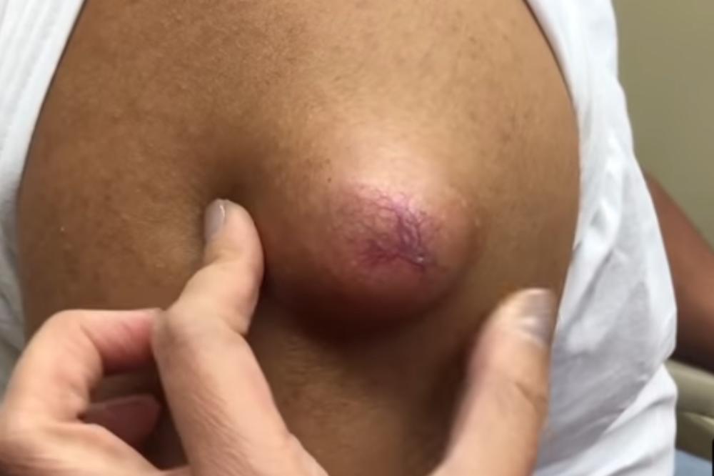 ODVRATNO, a 3,5 MILIONA ljudi ga GLEDALO! Snimak uklanjanja ciste od kojeg će vam biti MUKA! (UZNEMIRUJUĆI VIDEO)