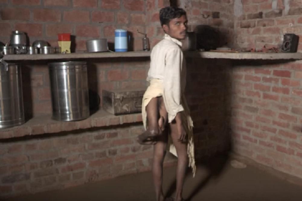 On ima 4 noge i svi mu se smeju zbog toga: UŽASNA ISPOVEST ovog dečaka nateraće vas da zaplačete! (VIDEO)