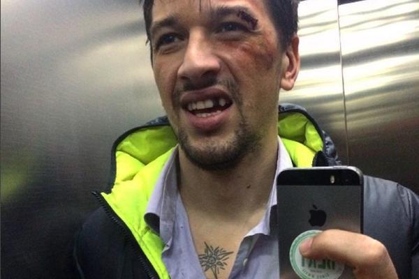 UNAKAZILI GA: Ko je OVAKO prebio Viktora Savića!? (FOTO)