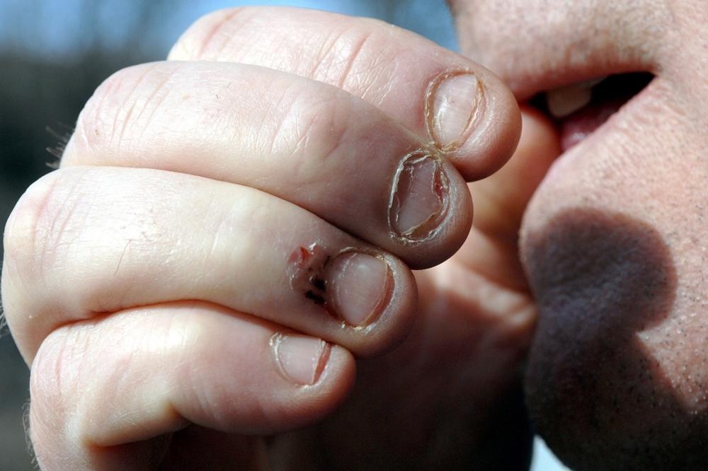 Grickate nokte? Ovo će vas naterati da odmah prestanete!(FOTO)