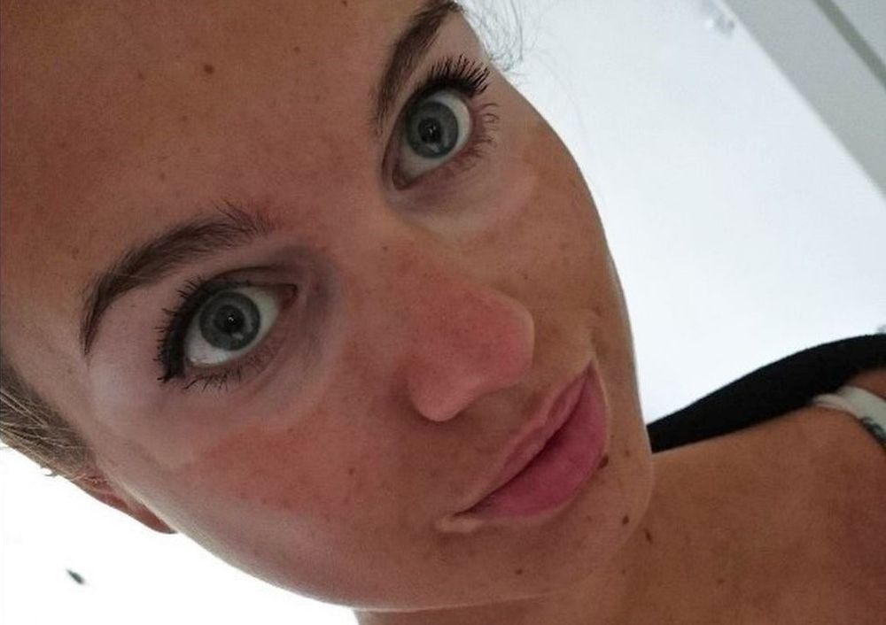 Vitiligo - flekice na koži