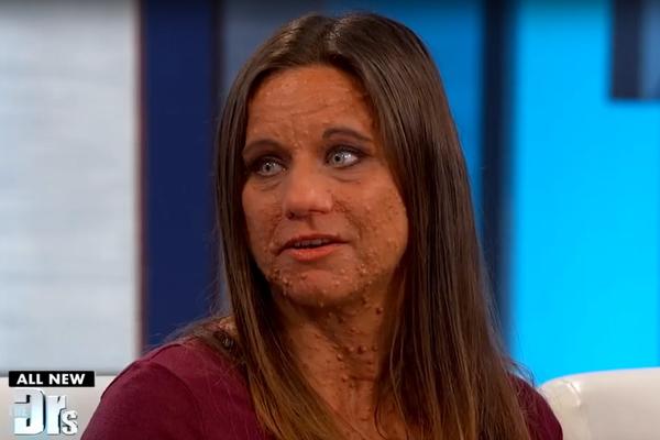 NE MOŽE DA ŽIVI OD BOLOVA! Ona ima više od 6000 TUMORA po celom telu i zbog toga je svi izbegavaju! (FOTO) (VIDEO)