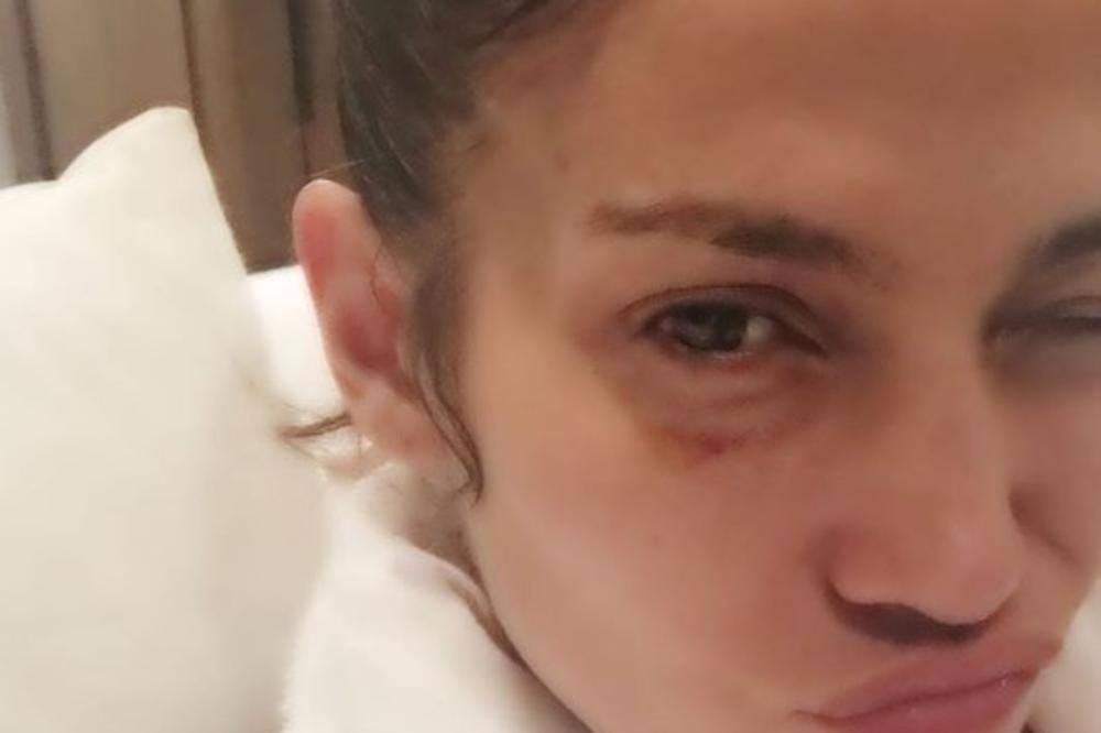 PEVAČICA zabrinula javnost, objavila fotku sa MASNICOM ispod oka! (FOTO)