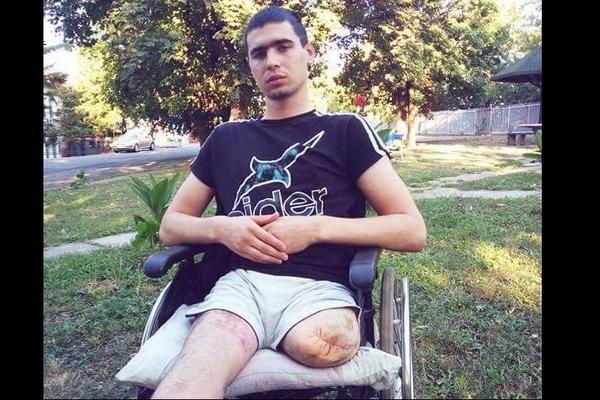LAZAR JE ZBOG RUPE NA PUTU OSTAO BEZ OBE NOGE! Njegova priča slama dušu, pomozimo mu da ponovo hoda! (FOTO)